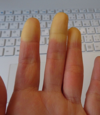 Raynaud'n oireyhtymä ja uni — miksi kädet ja jalat jäätyvät öisin ja kuinka taistella sitä vastaan Raynaud'n oireyhtymä ja uni — miksi kädet ja jalat jäätyvät öisin ja kuinka taistella sitä vastaan